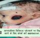  14 days old black fungus patient operate in Agra #agranews