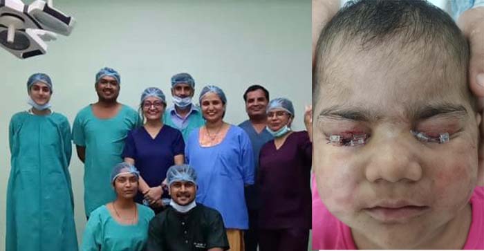  Agra News: SN doctors did successful surgery of mucous membrane grafting by taking membrane from the lip of a four-year-old girl…#agranews