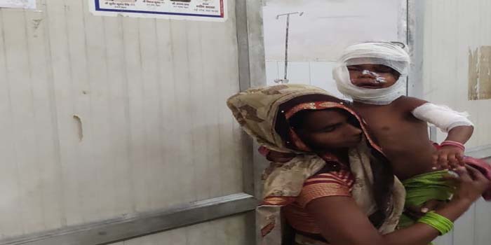  Agra News : Dog attack on 5 year old child, 24 stitch in mouth & neck #agra